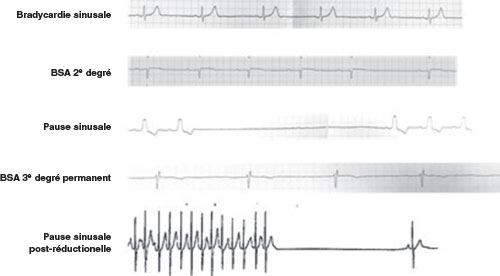 principales anomalies electrocardiographiques observees dans le cadre de la dysfonction sinusale.