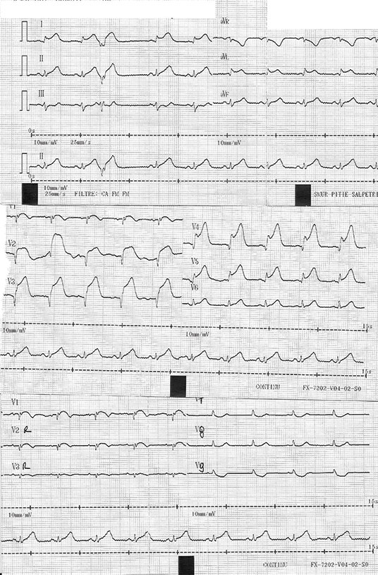 electrocardiogramme d'un infarctus du myocarde anterieur