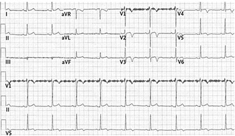 electrocardiogramme avec ondes t negatives en antero-septo-apical de v1 a v4