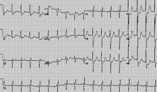 electrocardiogramme avec sous-decalage du segment st en d1avi et de v4 a v6