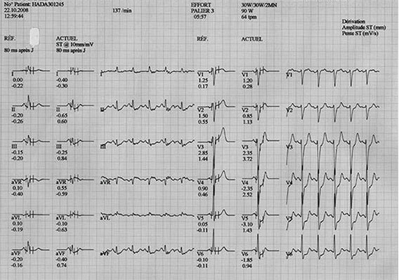 mise en evidence d'une ischemie myocardique par l'electrocardiogramme d'effort