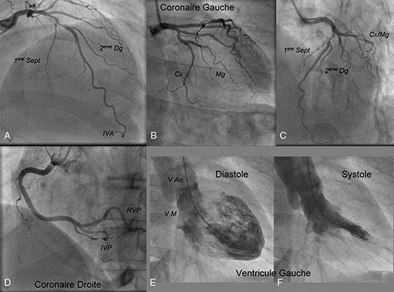 coronarographie retrouvant une stenose de l'artere interventriculaire anterieure moyenne et une coronaire droite angiographiquement normale