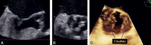 valve aortique bicuspide en vue transoesophagienne bidimensionnelle et tridimensionnelle