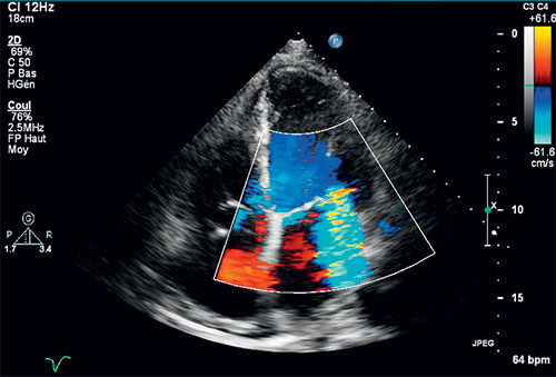echocardiographie couplee au doppler couleur