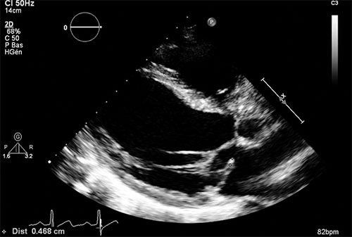 echocardiographie bidimensionnelle d'un prolapsus du feuillet posterieur avec probable rupture de cordage en incidence parasternale grand axe