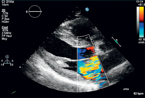 echocardiographie couplee au doppler couleur mettant en evidence le jet d'insuffisance mitrale excentré vers la partie postérieure de l'aorte en rapport avec le prolapsus du feuillet posterieur en incidence parasternale grand axe