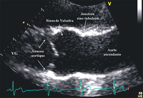 racine de l'aorte vue de profil en echocardiographie