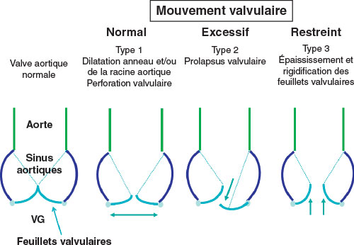 mecanisme de fuite aortique en fonction de la mobilite des cusps ou sigmoides aortiques