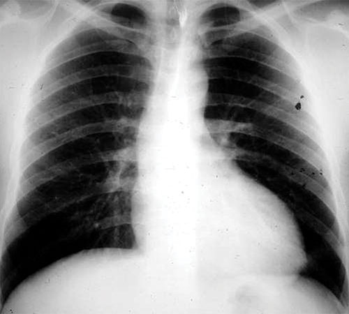 radiographie de thorax de face