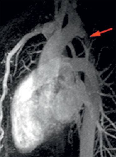 coarctation aortique du nouveau-ne