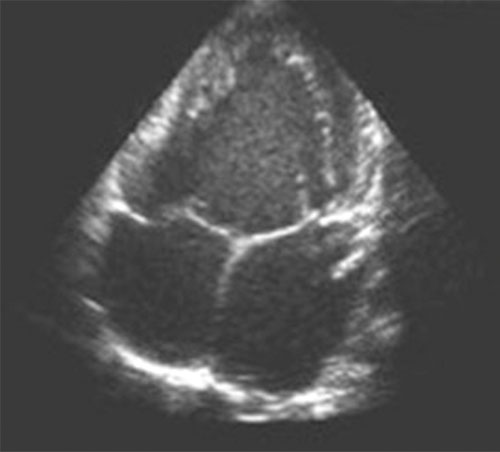 ventricule unique : echocardiographie transthoracique, incidence apicale des 4 cavites