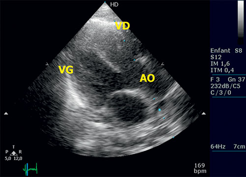 tetralogie de fallot : echocardiographie transthoracique en grand axe parasternal gauche