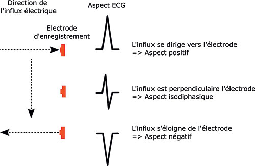 positionnement des electrodes precordiales