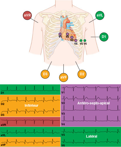 territoires cardiaques selon les derivations ECG