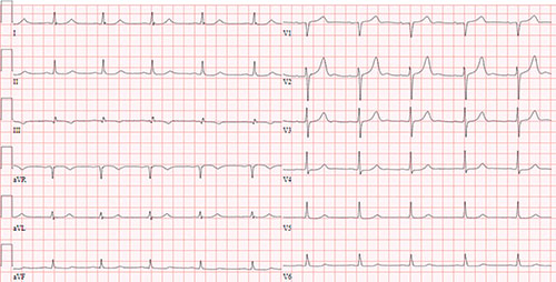 electrocardiogramme normal