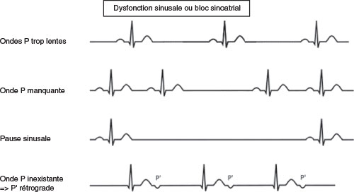 differents aspects de dysfonction sinusale en pratique clinique