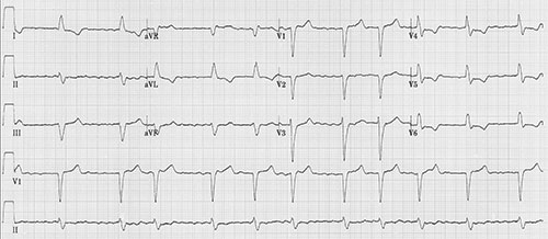 defibrillation atriale à petites mailles, bien visibles sur le long trace D2, et bloc de branche gauche complet