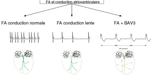 fibrillation atriale et differents niveaux de conduction atrioventriculaire
