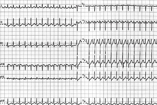 tachycardie jonctionnelle, reguliere à QRS fins, pas d'activite atriale visible : probable tachycardie par reentree intranodale typique