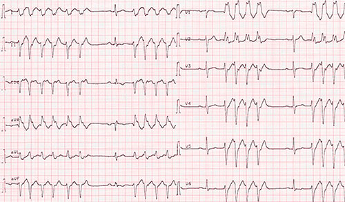 aspect de tachycardie ventriculaire non soutenue