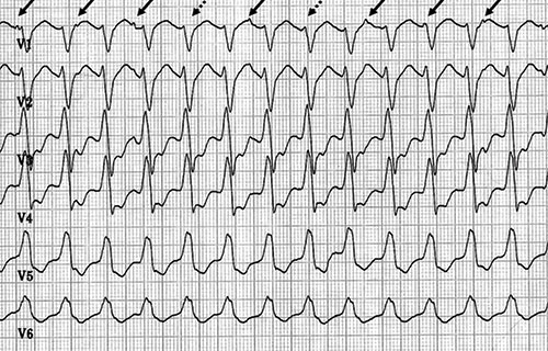 tachycardie ventriculaire car à QRS larges, reguliere avec dissociation ventriculoatriale