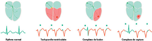 schema d'une capture et d'une fusion pendant une tachycardie ventriculaire (TV)