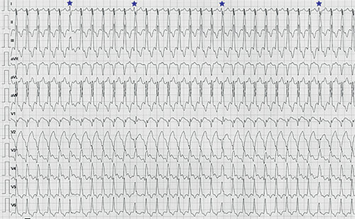 tachycardie ventriculaire car tachycardie reguliere à QRS larges avec presence de fusions (QRS n° 6, 12, 20, etc.), surtout visibles en V1