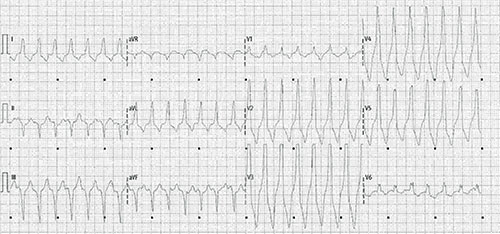 tachycardie ventriculaire car tachycardie à QRS larges, concordance positive dans les precordiales