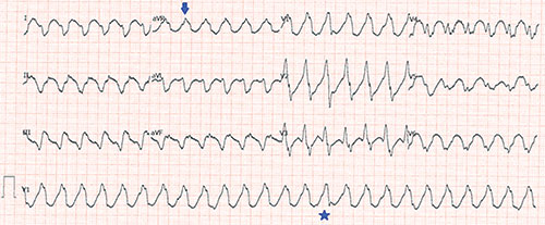tachycardie ventriculaire car tachycardie à QRS tres large, un QRS de fusion (etoile)