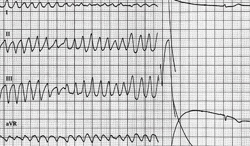 fibrillation ventriculaire en larges fuseaux, puis retour en rythme sinusal par choc electrique.
