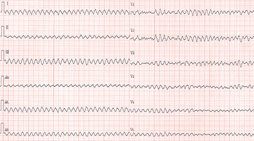 electrocardiogramme d'une fibrillation ventriculaire (FV) en 12D