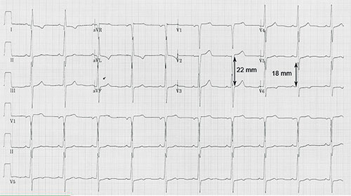 hypertrophie ventriculaire gauche, Sokolow à 40 mm, « pseudo » sus-decalage du segment ST en V1 et V2, onde T negative en D1, aVL, V6