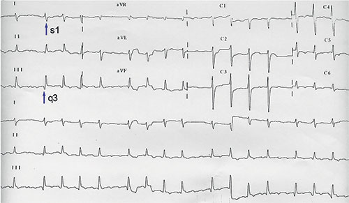 electrocardiogramme pendant une embolie pulmonaire, deviation axiale droite, S1Q3, fibrillation atriale