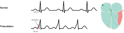 le passage de l'influx electrique de l'oreillette au ventricule est une competition entre le passage normal par le nœud atrioventriculaire (NAV) et celui par la voie accessoire (VA), qui se caracterise par une superposition des 2 activations ventriculaires (par le NAV et par la VA) a l'origine de l'onde δ