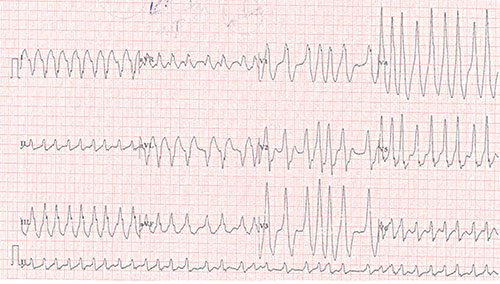 tachycardie irreguliere à QRS larges, de taille variable, dits « en accordeon »