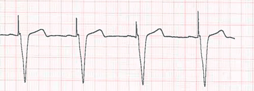 electroentrainement ventriculaire, avec spike unipolaire de stimulation devant les QRS