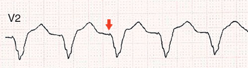 electroentrainement ventriculaire, avec spike bipolaire de stimulation devant les QRS
