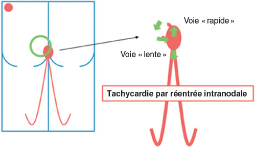 mecanisme d'une tachycardie par reentree intranodale
