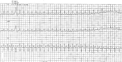 tachycardie reguliere, a QRS fins, à 150 bpm