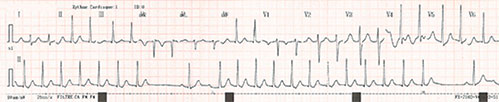 tachycardie jonctionnelle par reentree intranodale incessante avec arret (P' negatives en inferieure) puis récidive après passage de la conduction sinusale sur les deux voies (PR normal, puis PR long).