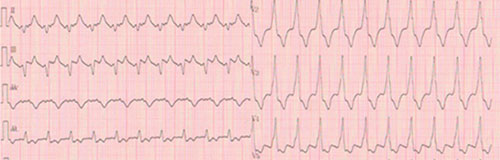 tachycardie antidromique : reguliere, QRS larges avec aspect de preexcitation bien visible en V2, V3, V4.