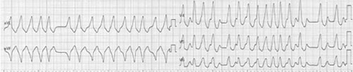 fibrillation atriale sur voie accessoire avec frequence ventriculaire irreguliere et tres rapide : aspect variable des complexes QRS
