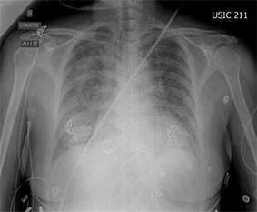 oedeme pulmonaire radiologique