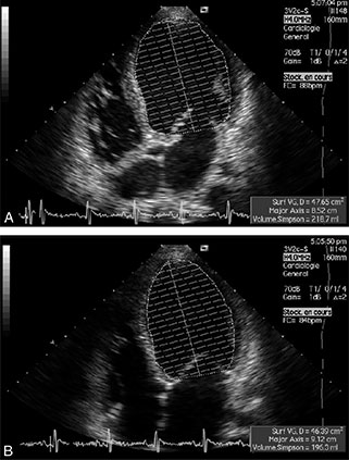 mesure echocardiographique du volume telediastolique (A) et telesystolique (B) du ventricule gauche chez un patient ayant une cardiomyopathie dilatee permettant de calculer la fraction d'ejection ventriculaire gauche