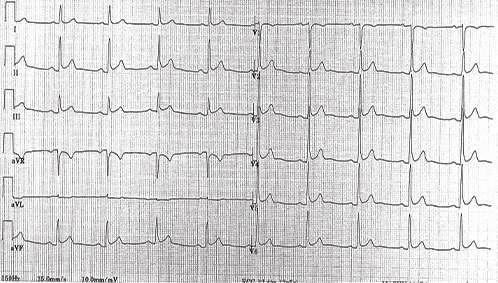 electrocardiogramme d'une pericardite aigue avec sous-decalage de PQ et sus-decalage du segment ST concave vers le haut et diffus