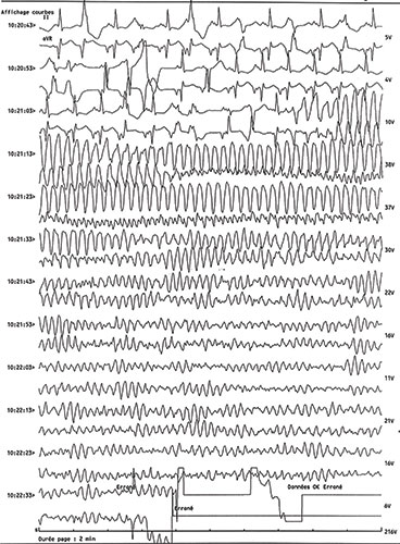 exemple d'electrocardiogramme de fibrillation ventriculaire