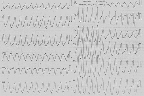 exemple d'electrocardiogramme de tachycardie ventriculaire