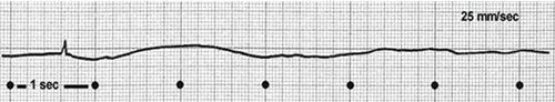 exemple d'electrocardiogramme d'asystolie